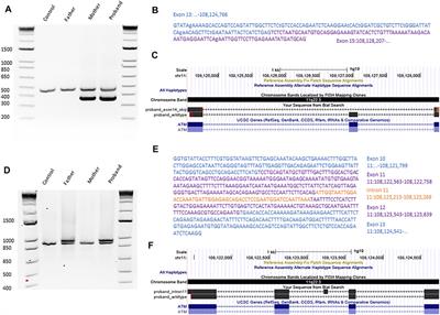 Case Report: Biallelic Loss of Function ATM due to Pathogenic Synonymous and Novel Deep Intronic Variant c.1803-270T > G Identified by Genome Sequencing in a Child With Ataxia–Telangiectasia